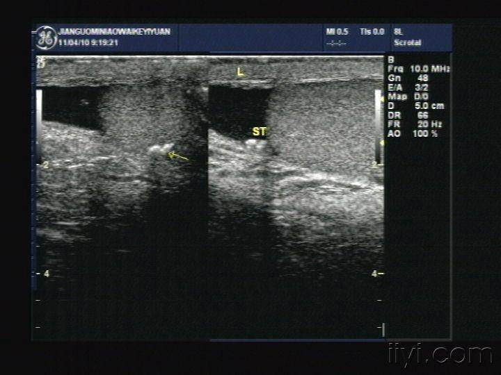 阴囊内睾丸鞘膜腔内结石