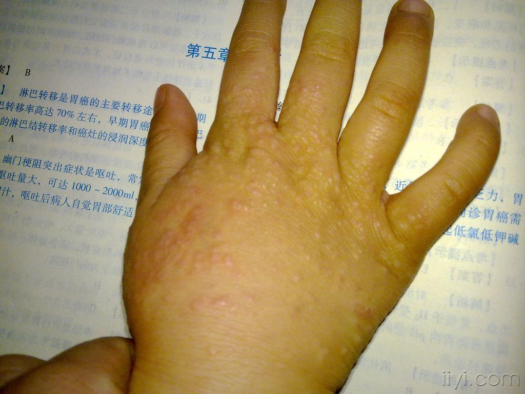 磨擦性苔癣样疹