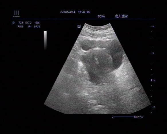 盆腔包块性质待查