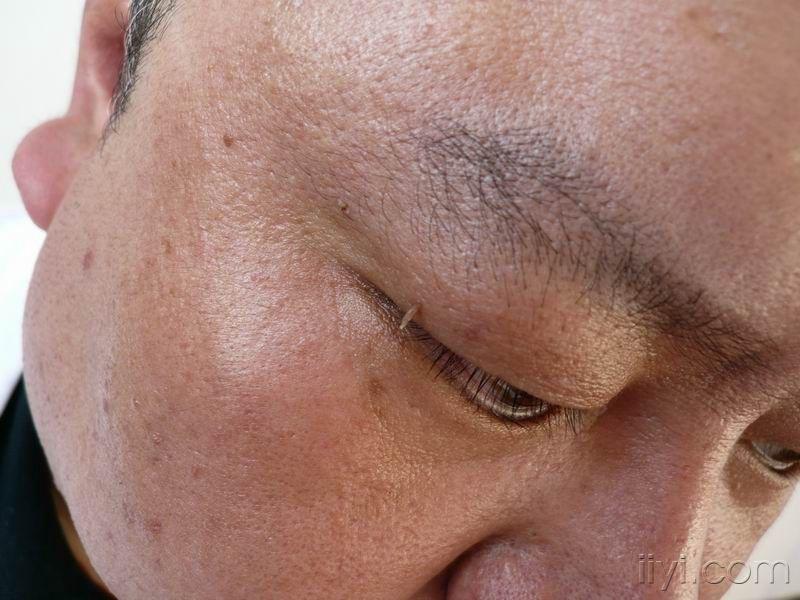 诊断:丝状疣