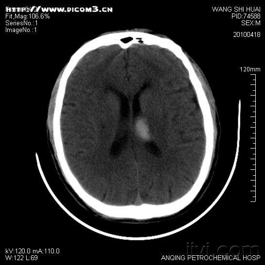 丘脑核磁共振图图片