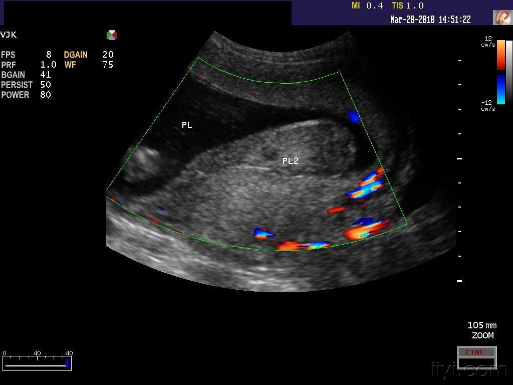 这是副胎盘吗 - 超声医学讨论版 - 爱爱医医学论坛 - 爱爱医医学网