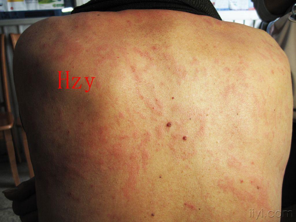 公布答案:玫瑰糠疹 - 皮肤及性传播疾病讨论版 - 爱爱医医学论坛
