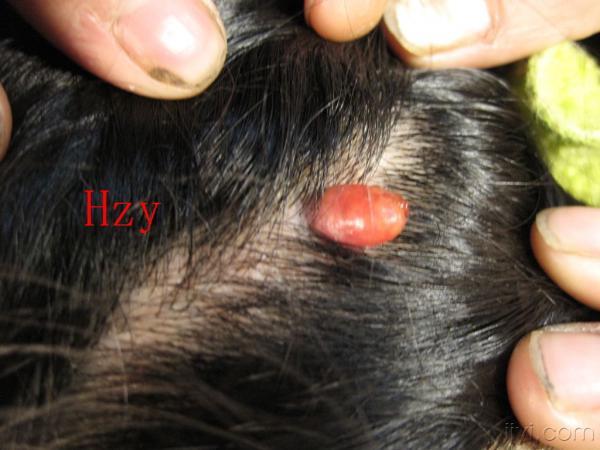 头皮上生了个小东西.公布答案:化脓性肉芽肿