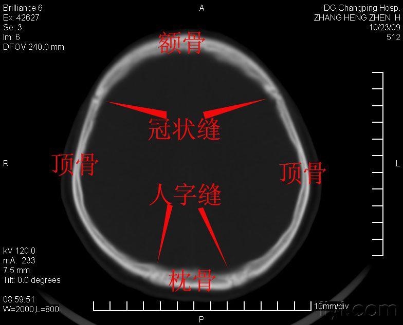 ct片頂骨骨折跟骨縫怎樣鑑別?