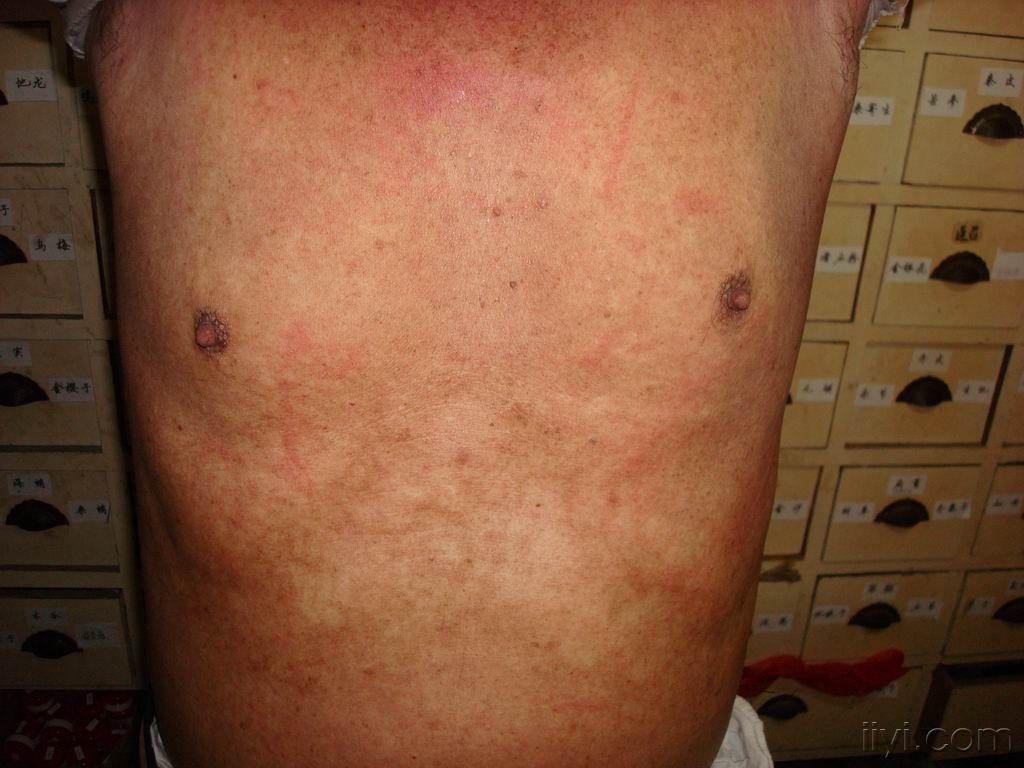 湿疹所致红皮病