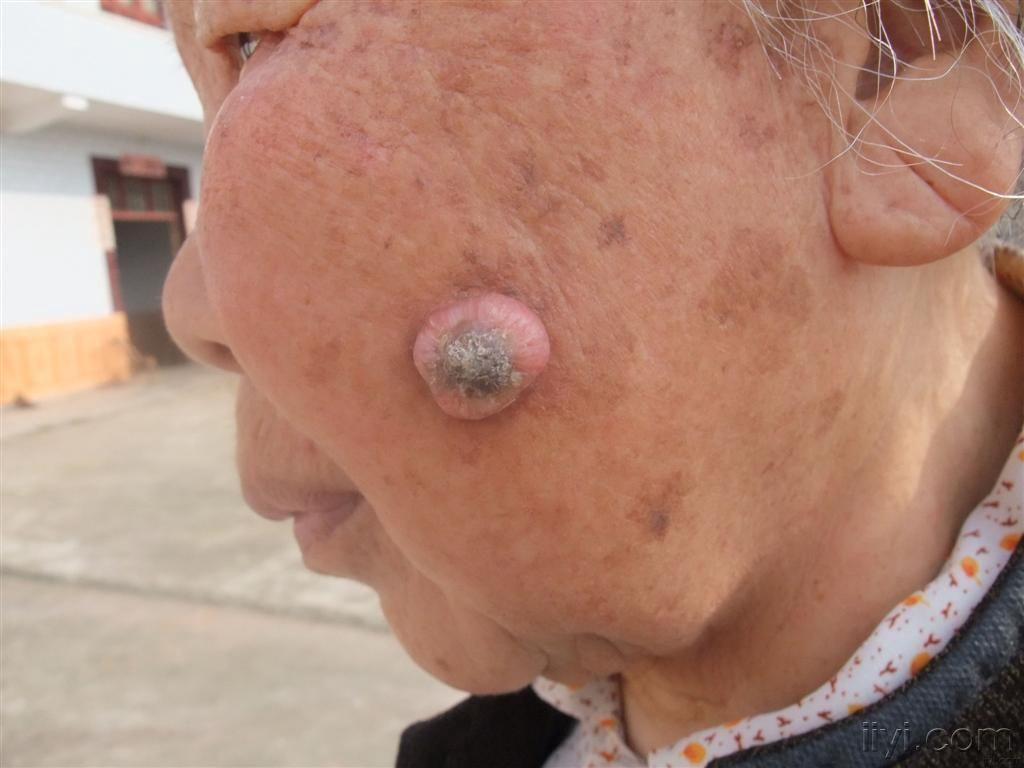 看图(送花)(更新,已做病理)