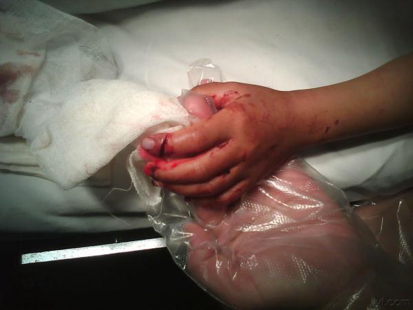 昨天做的一例手外伤手术