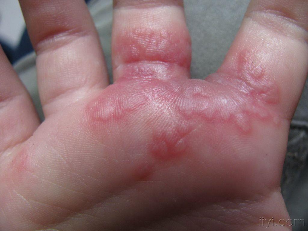 小手的皮疹---单纯疱疹