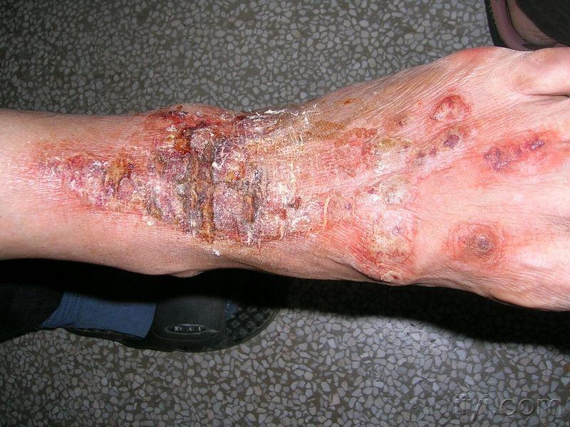 真菌皮炎症状图片