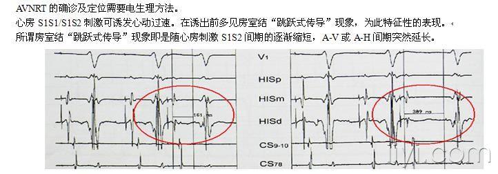 房室结折返性心动过速avnrt