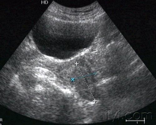 膀胱囊肿超声图片图片
