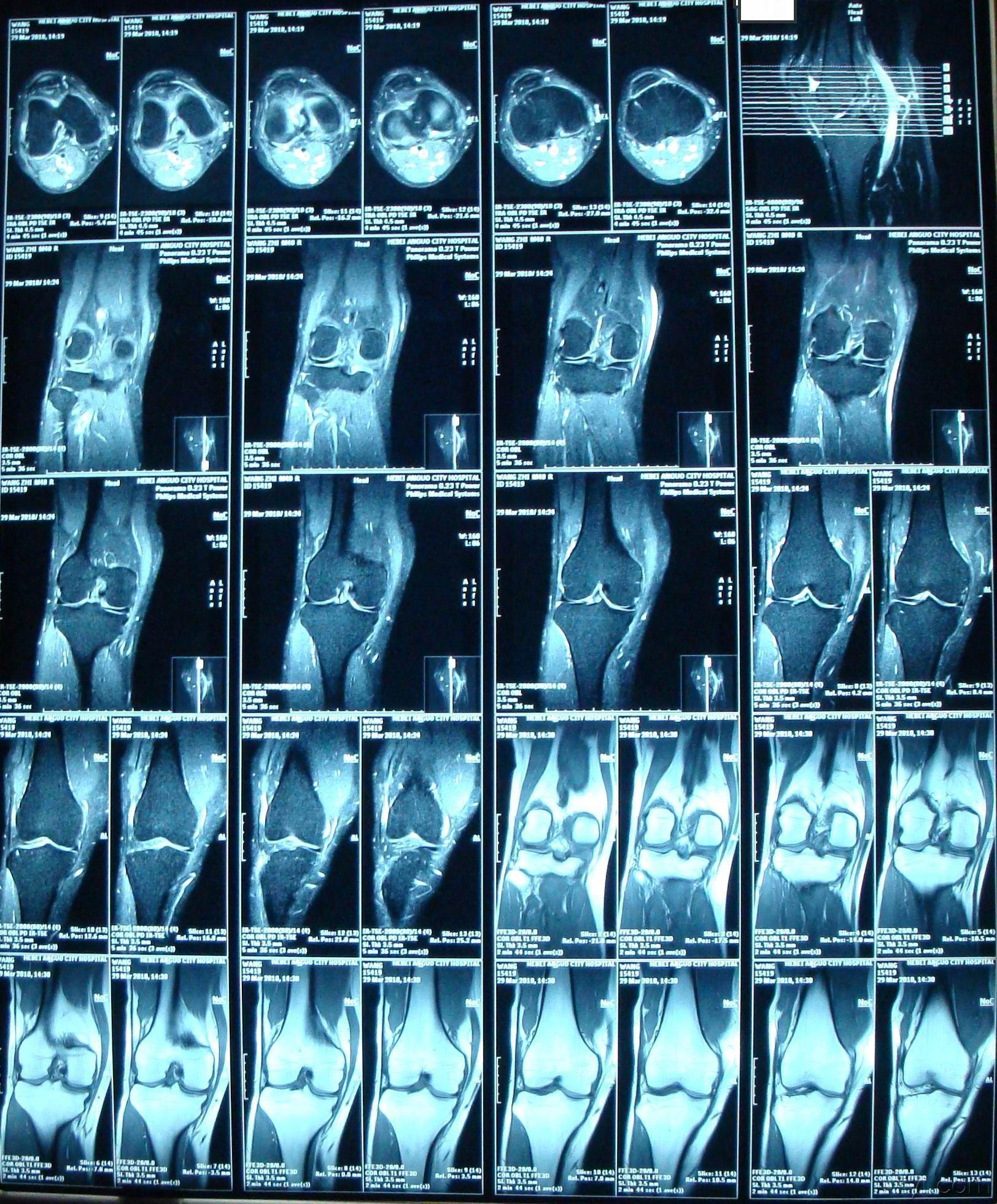 膝盖磁共振图像图片