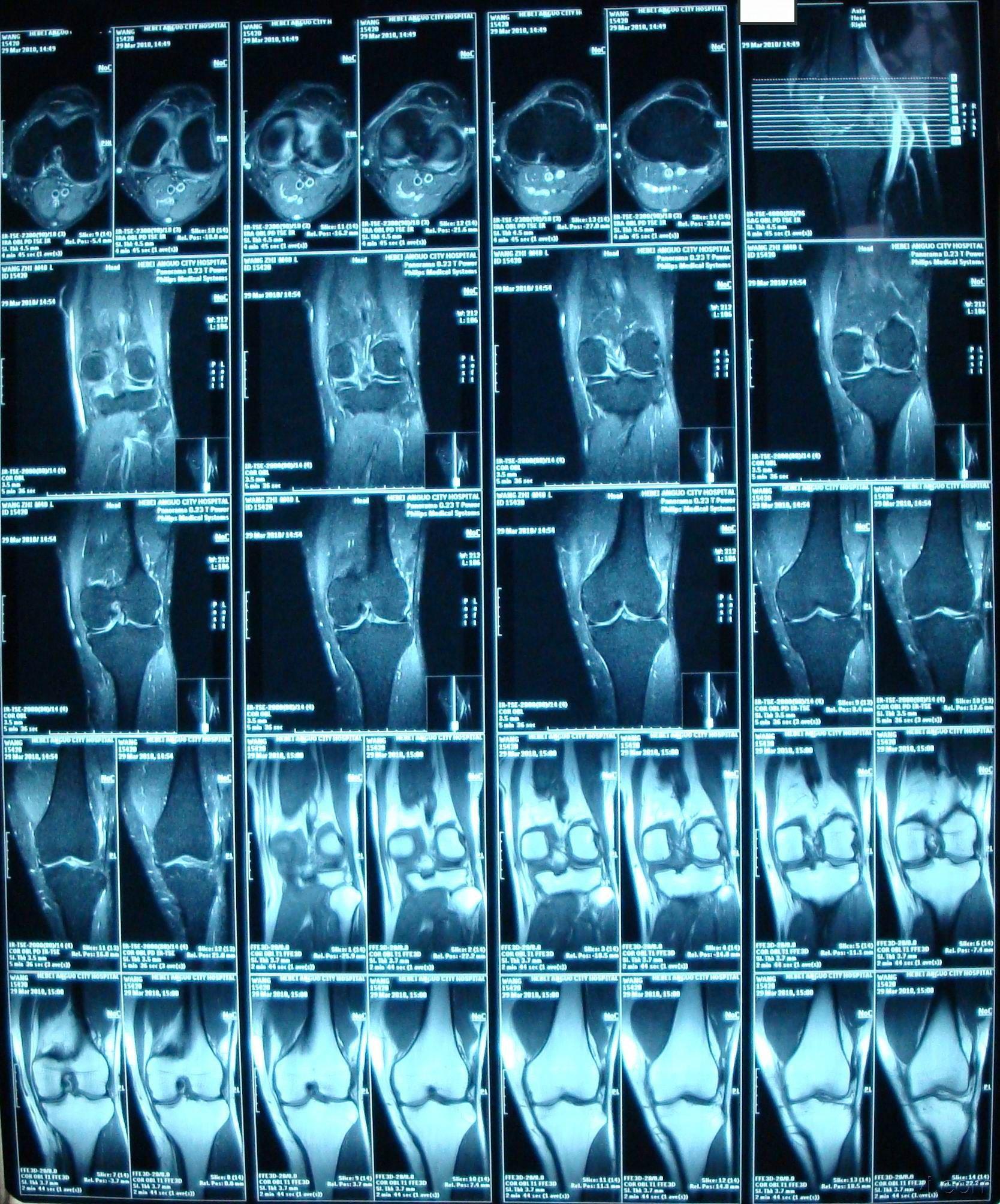 膝盖核磁共振结果图片
