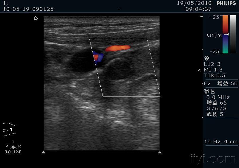左侧颌下腺低回声占位,作何诊断?