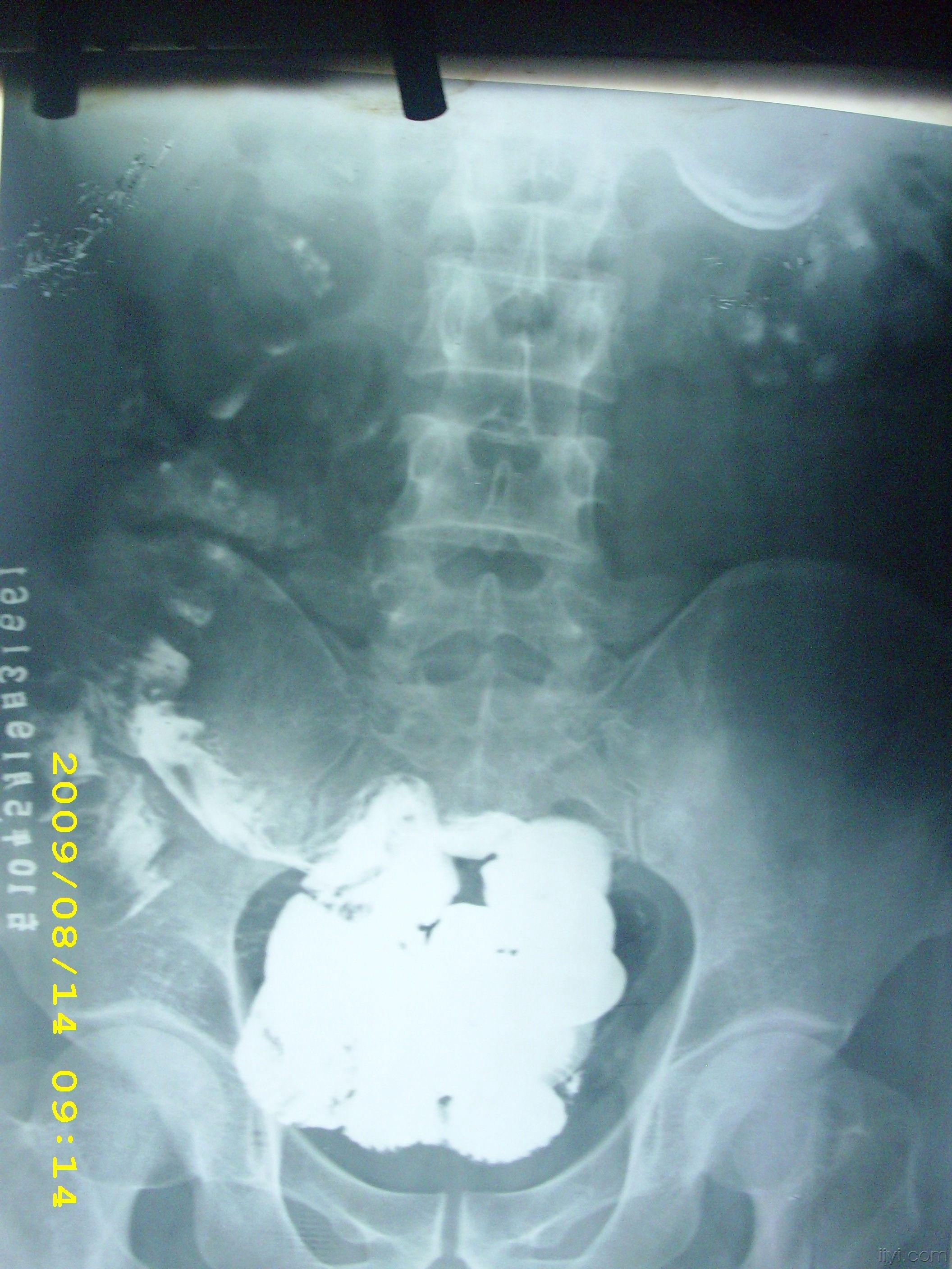 小肠钡剂造影请各位老师帮忙看片,急急急!