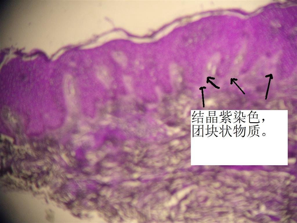 皮肤淀粉样变病理图片