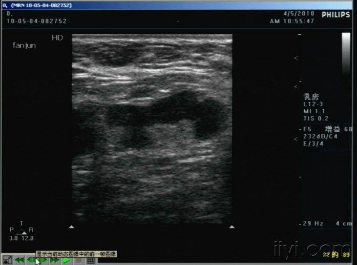 邊界清,於左乳外下探及片狀低迴聲區,內見散在斑塊狀強回聲
