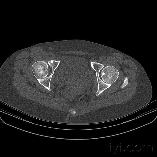 分享一例股骨头疝窝及骨岛!
