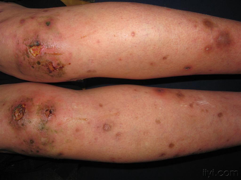 血管炎早期图片 皮肤图片