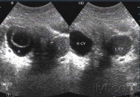卵巢囊肿彩超图片图片