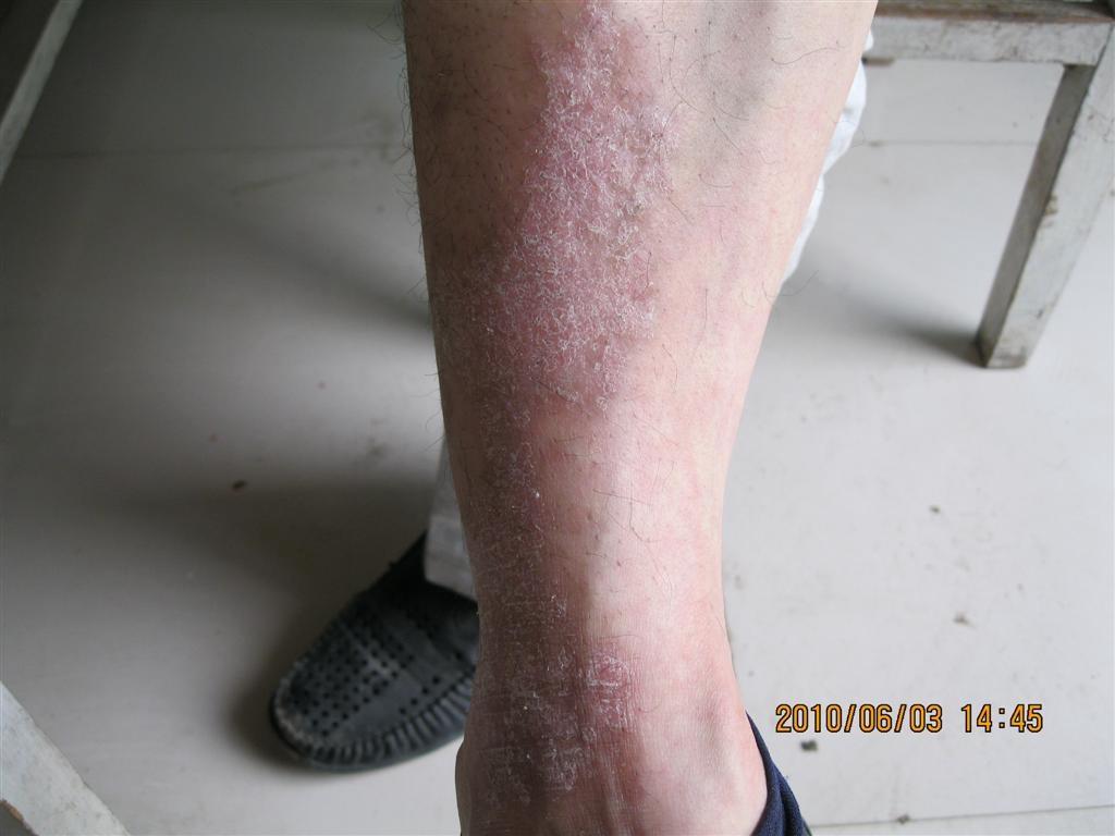 皮炎症状图片 腿部图片