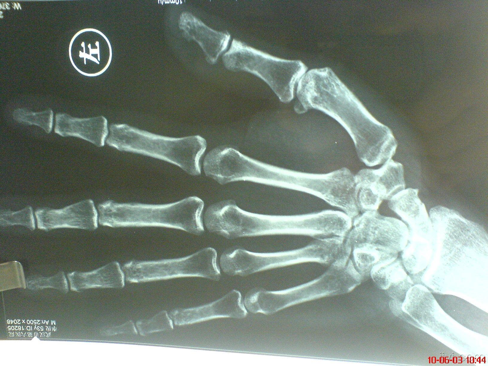 手指脱臼x光片图片