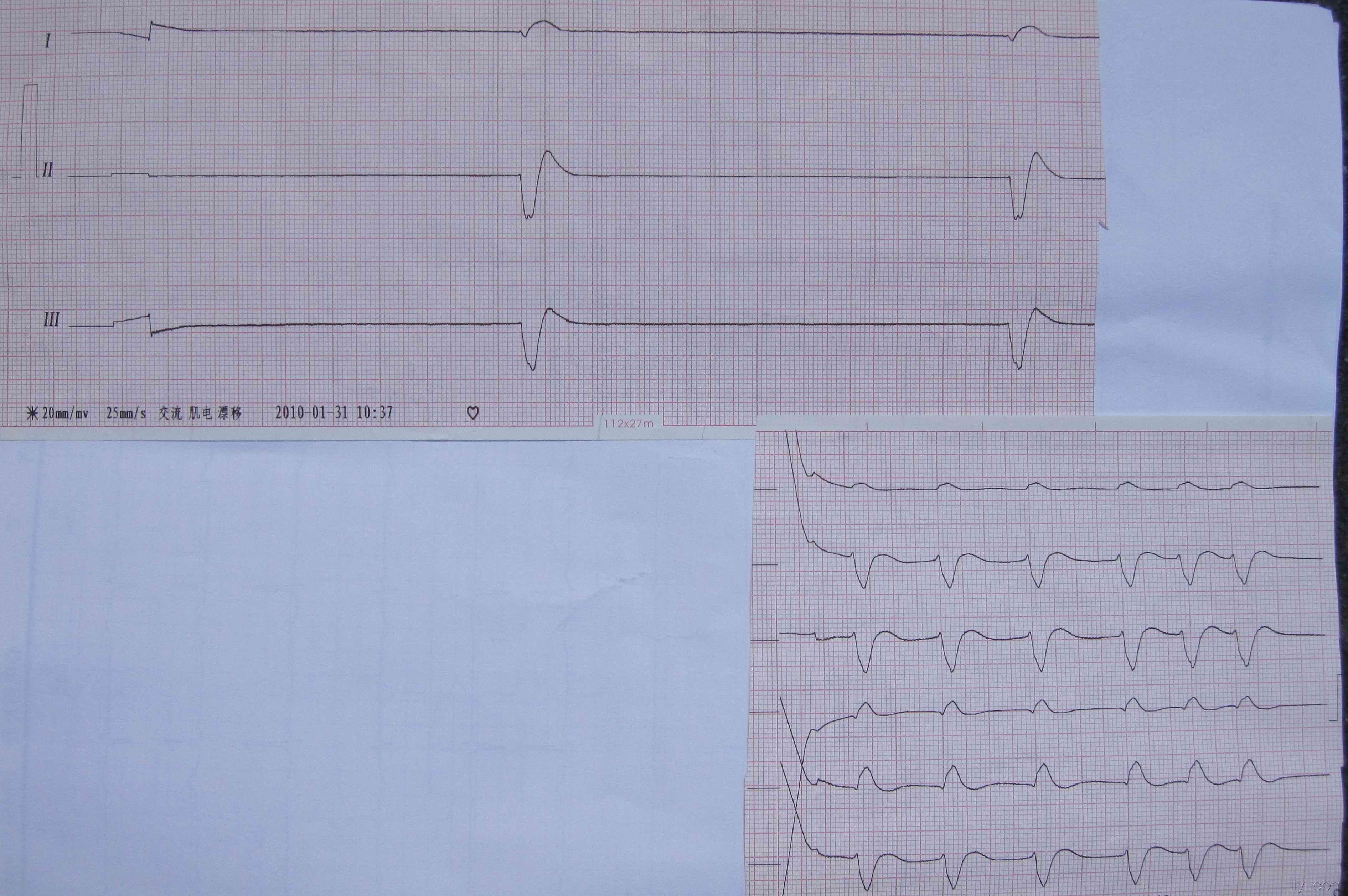 心脏停止跳动20分钟后,经心肺复苏出现的心电图