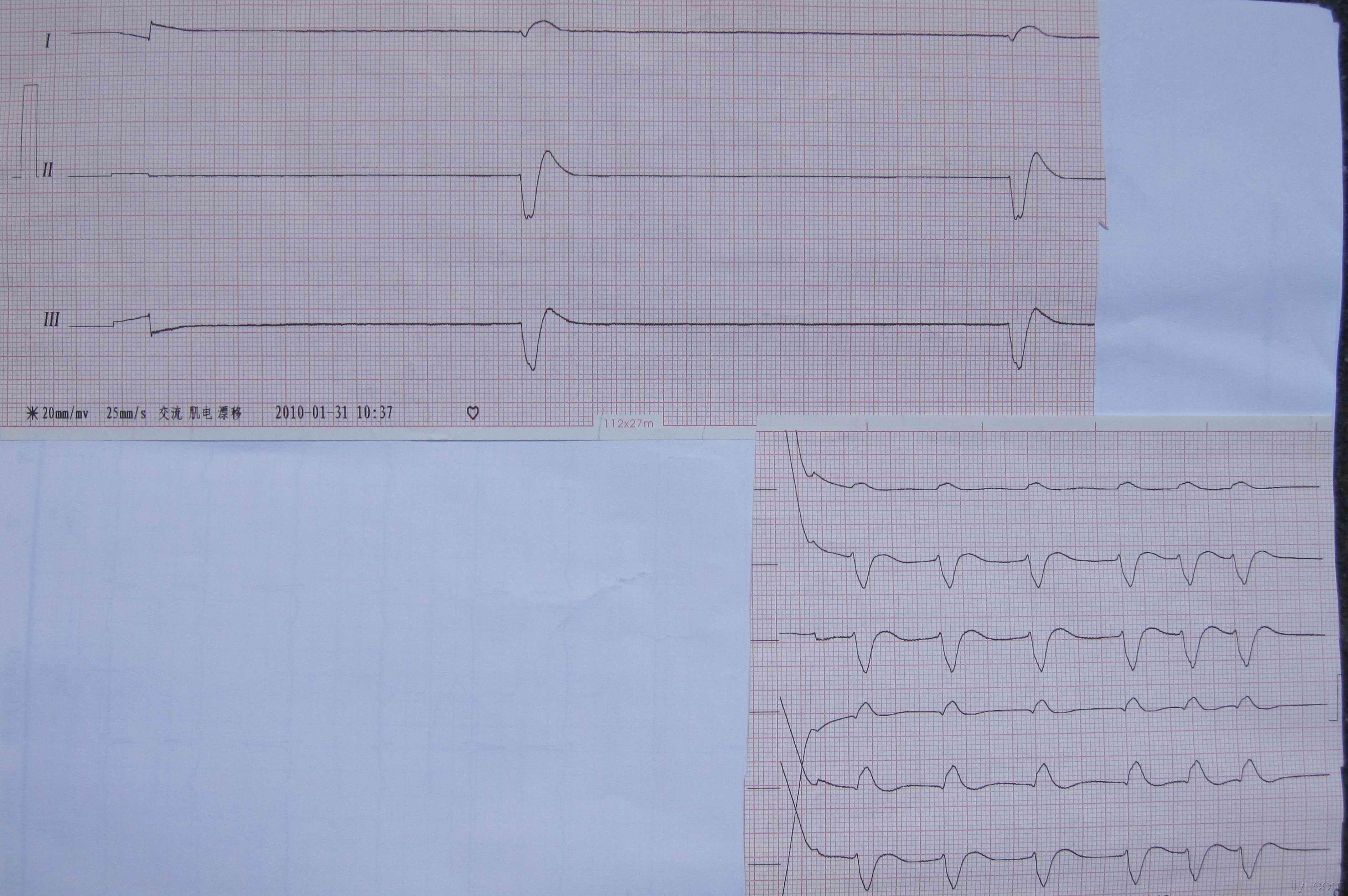心脏停跳心电图图片图片