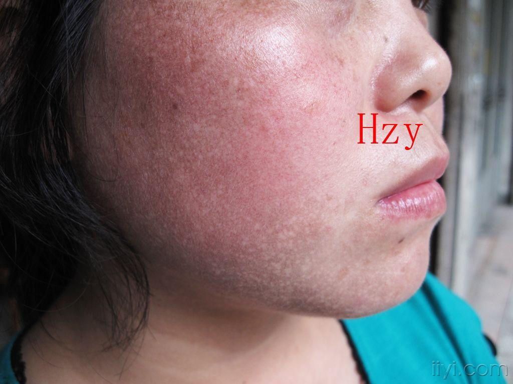 公布答案:西瓦特皮肤异色病.