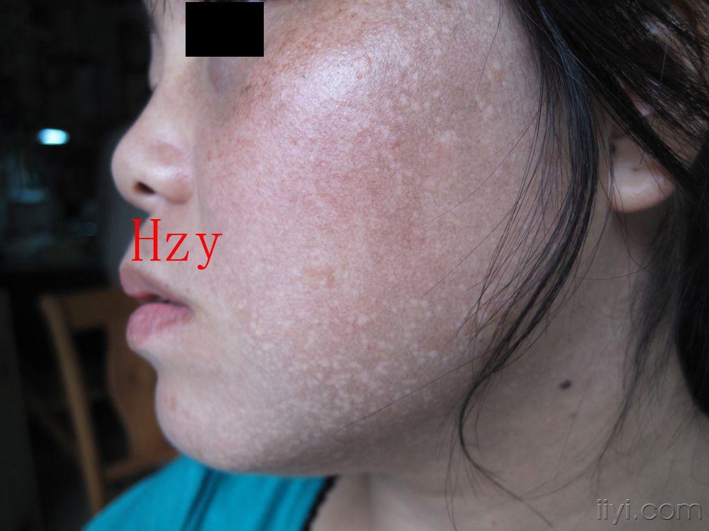 公布答案:西瓦特皮肤异色病.