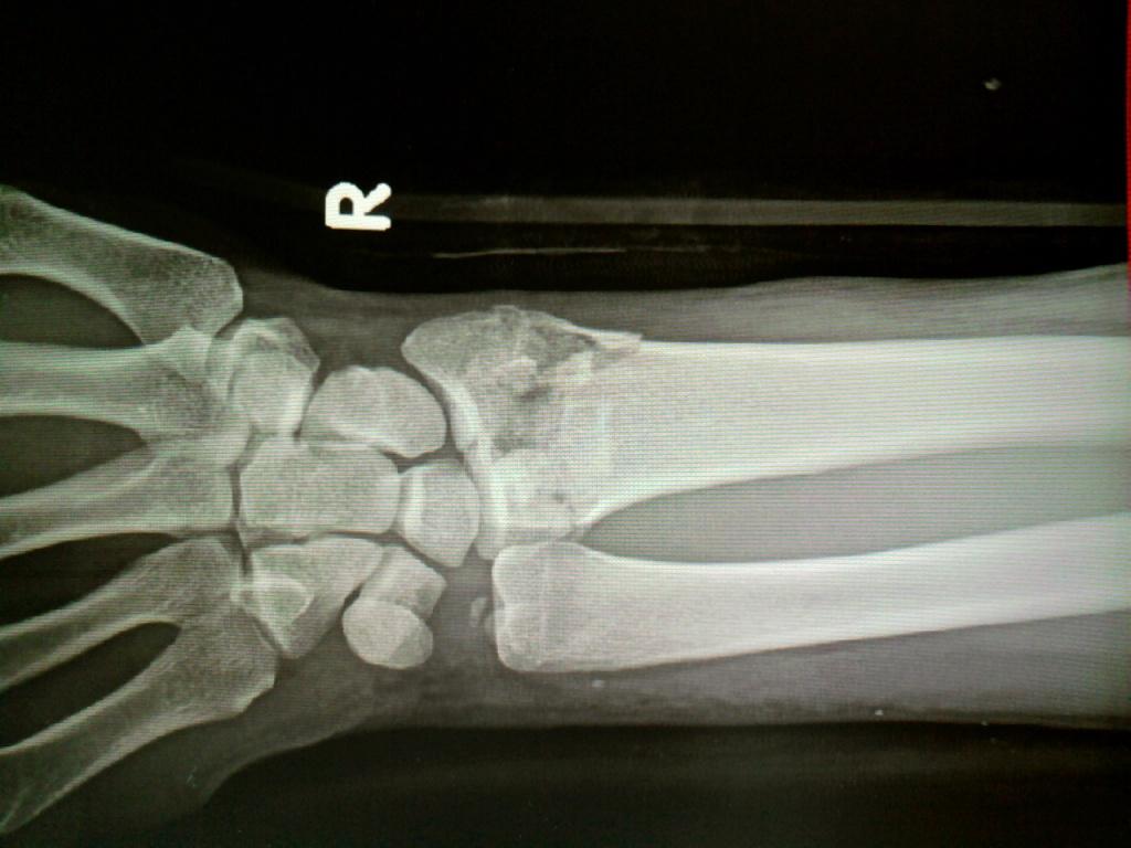 右桡骨远端骨折断裂图片