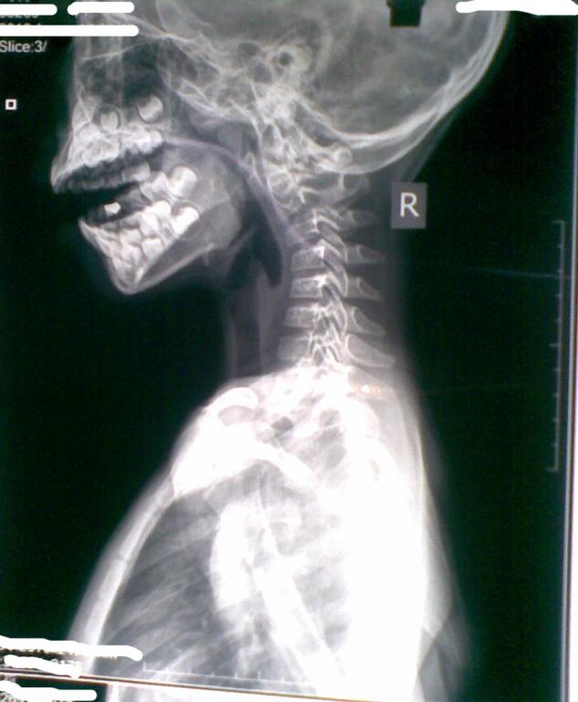 7岁女孩颈椎反张失稳x片