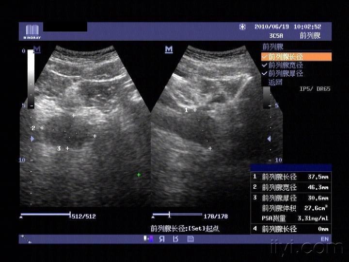 精囊腺超声图片图片