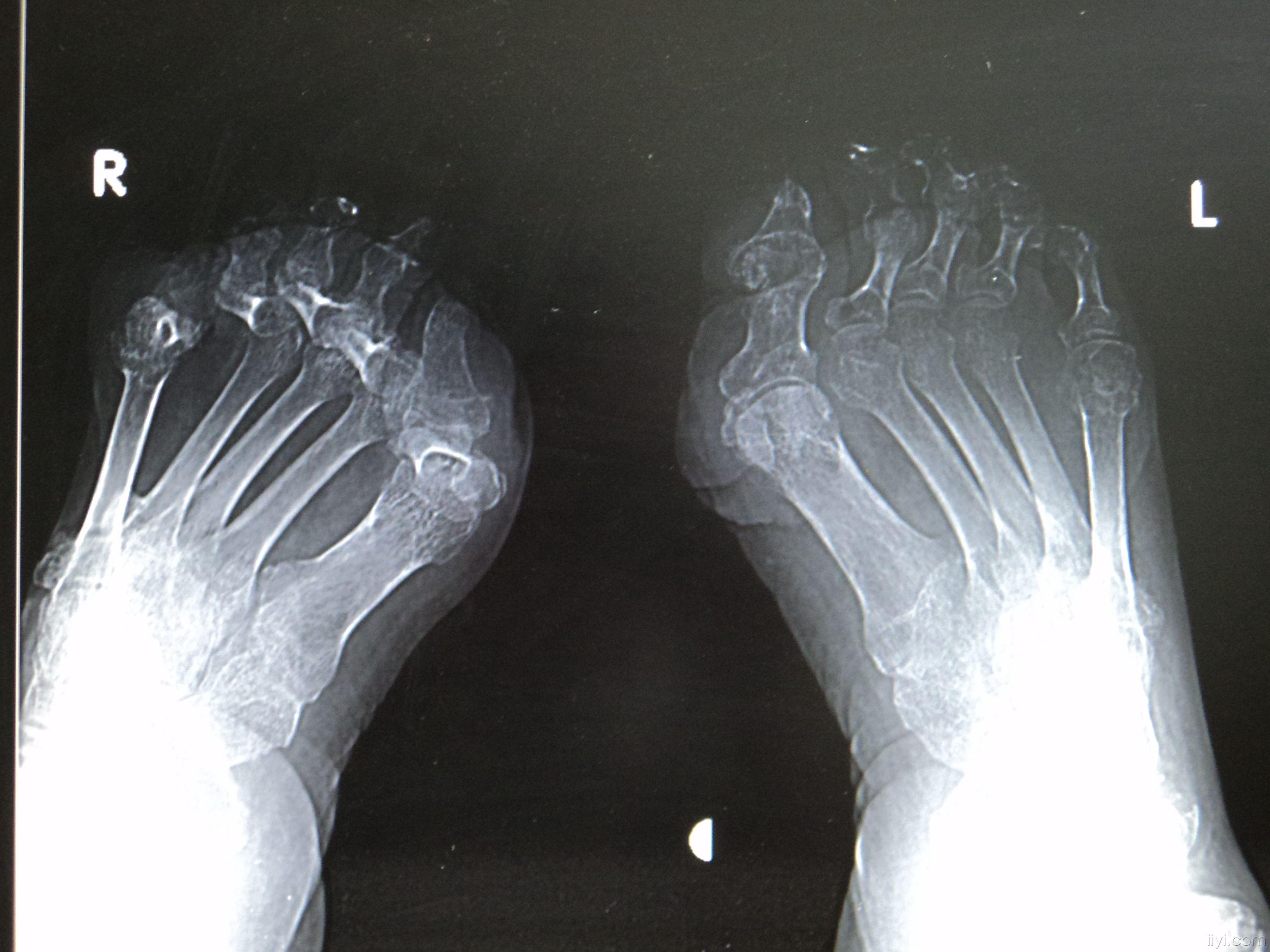 今天有幸见到少见的"麻风"病人的x线趾骨关节之影像