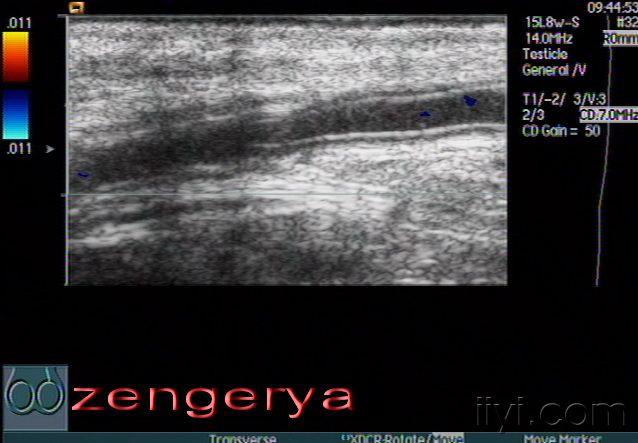 超声诊断输精管扩张——zengerya