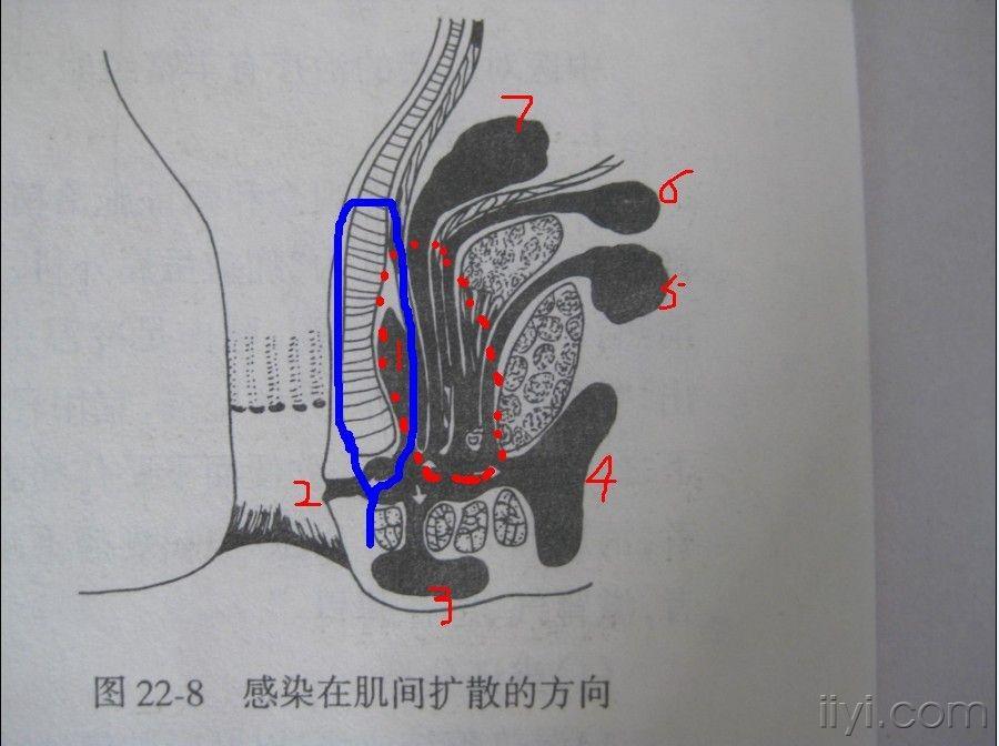 肛周脓肿手术挂线图片图片