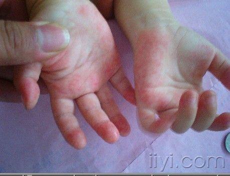 三岁宝宝手掌内红斑图片