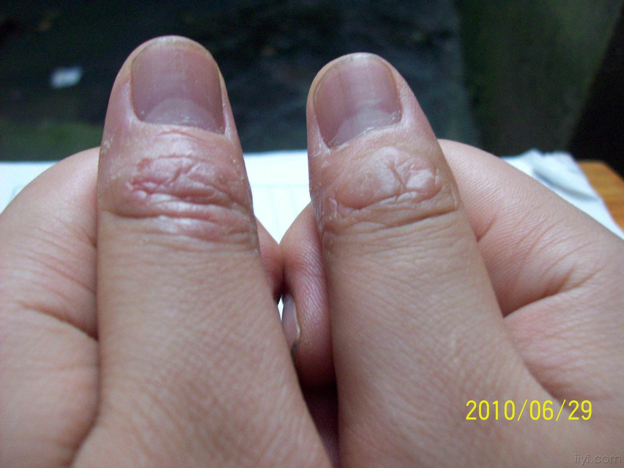 大拇指甲真菌感染图片图片