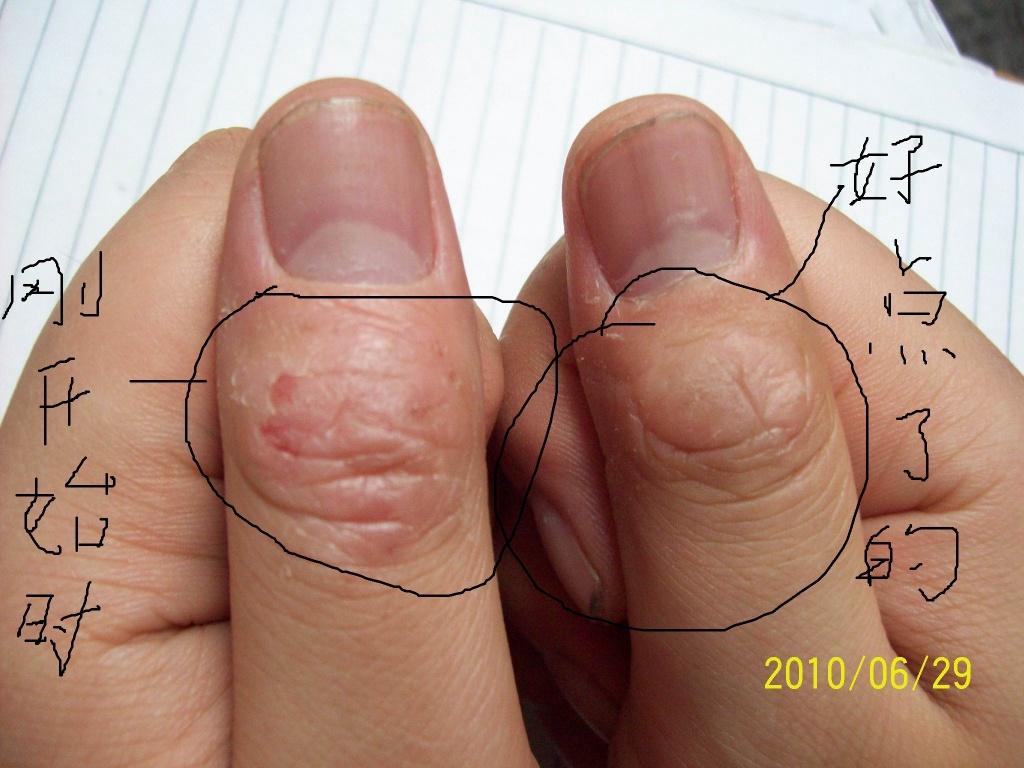 大拇指第一关节图图片