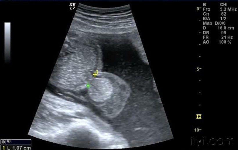胎儿脐膨出图片