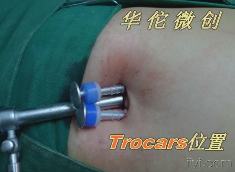 经脐单孔腹腔镜阑尾切除术