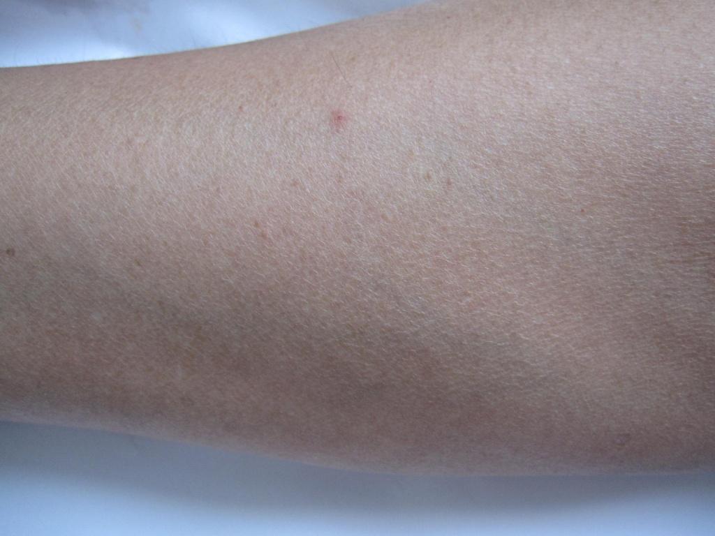 左手小臂外侧肿胀皮肤紫癜样改变