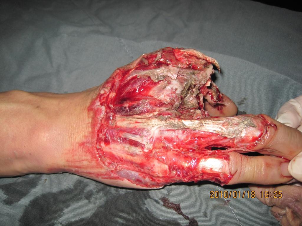 如此断指请高手们出招!