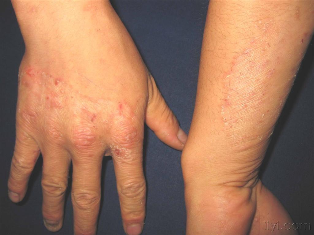看图识病----------手癣 - 皮肤及性传播疾病讨论版 - 爱爱医医学论坛