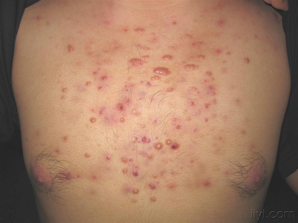 面颈部,肩胛部及胸前许多厚壁结节,或形成了大小不等的瘢痕疙瘩.