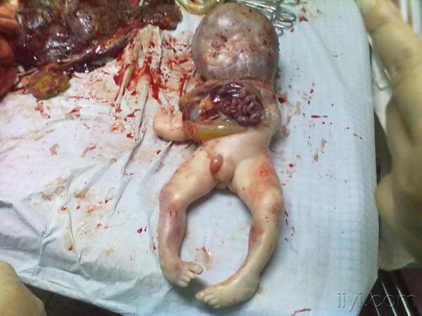 胎儿畸形图片真实图片