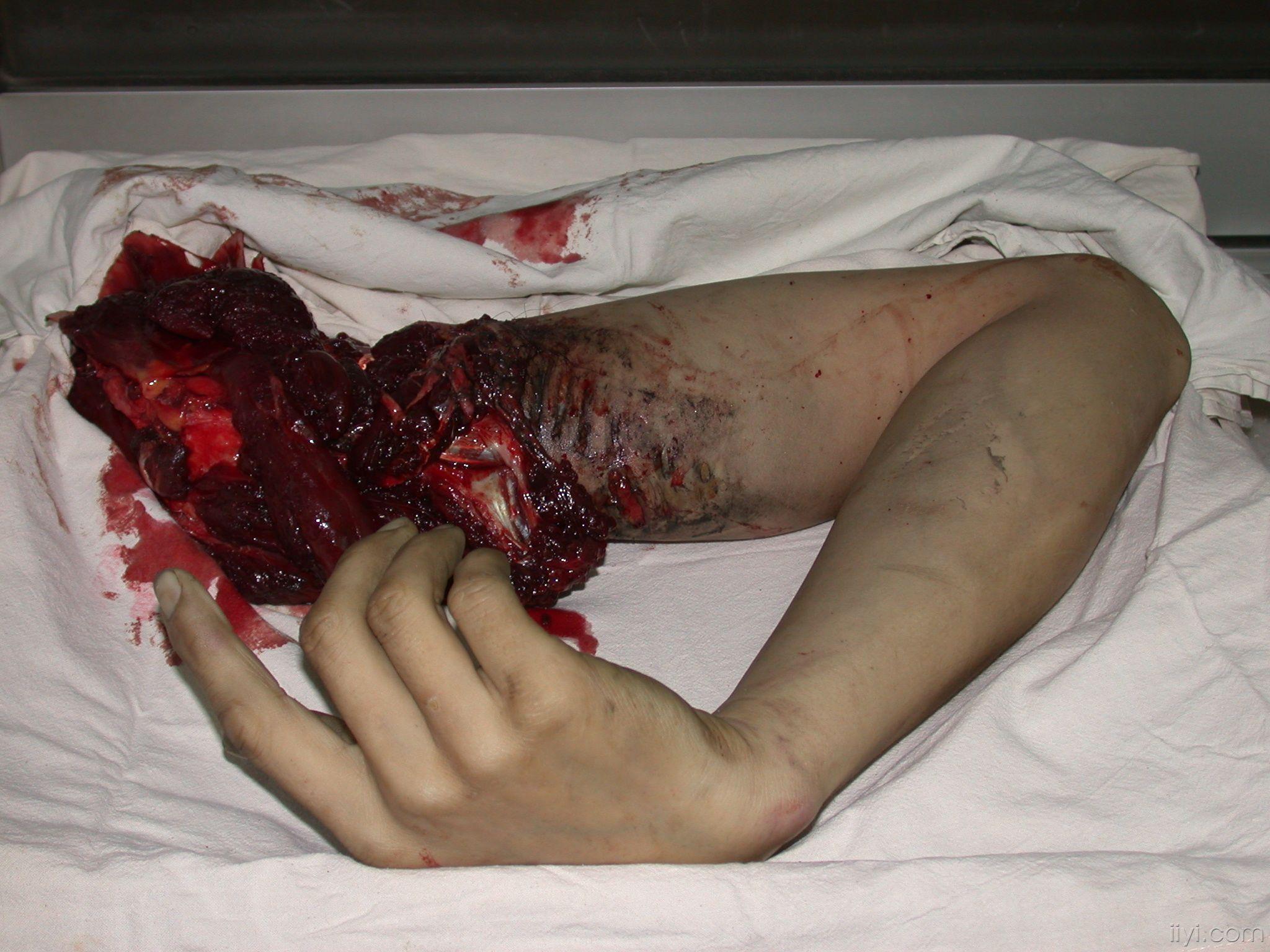 上肢离断伤一例报道