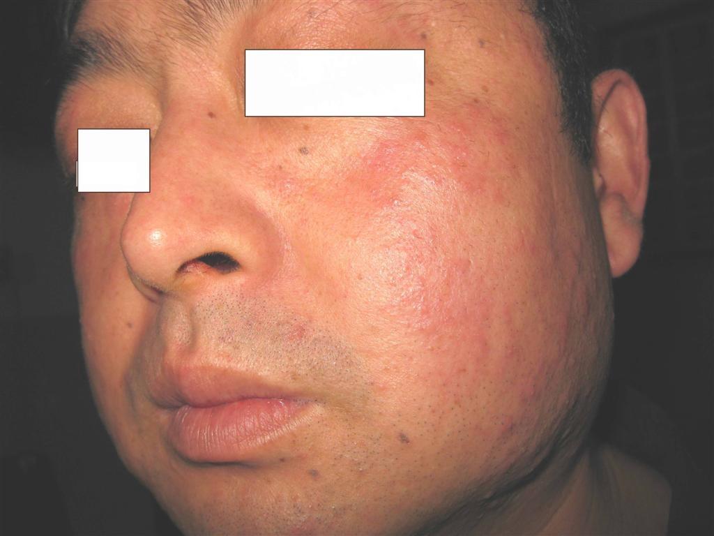 看图识病----------糖皮质激素副作用