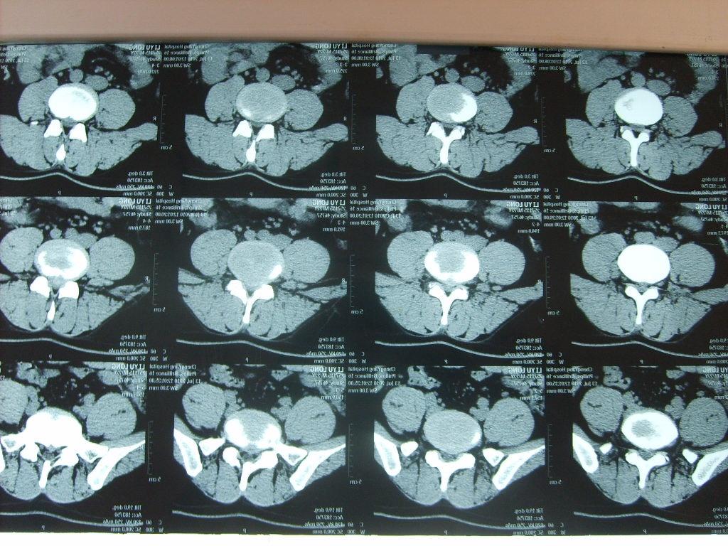 腰间盘突出ct图片
